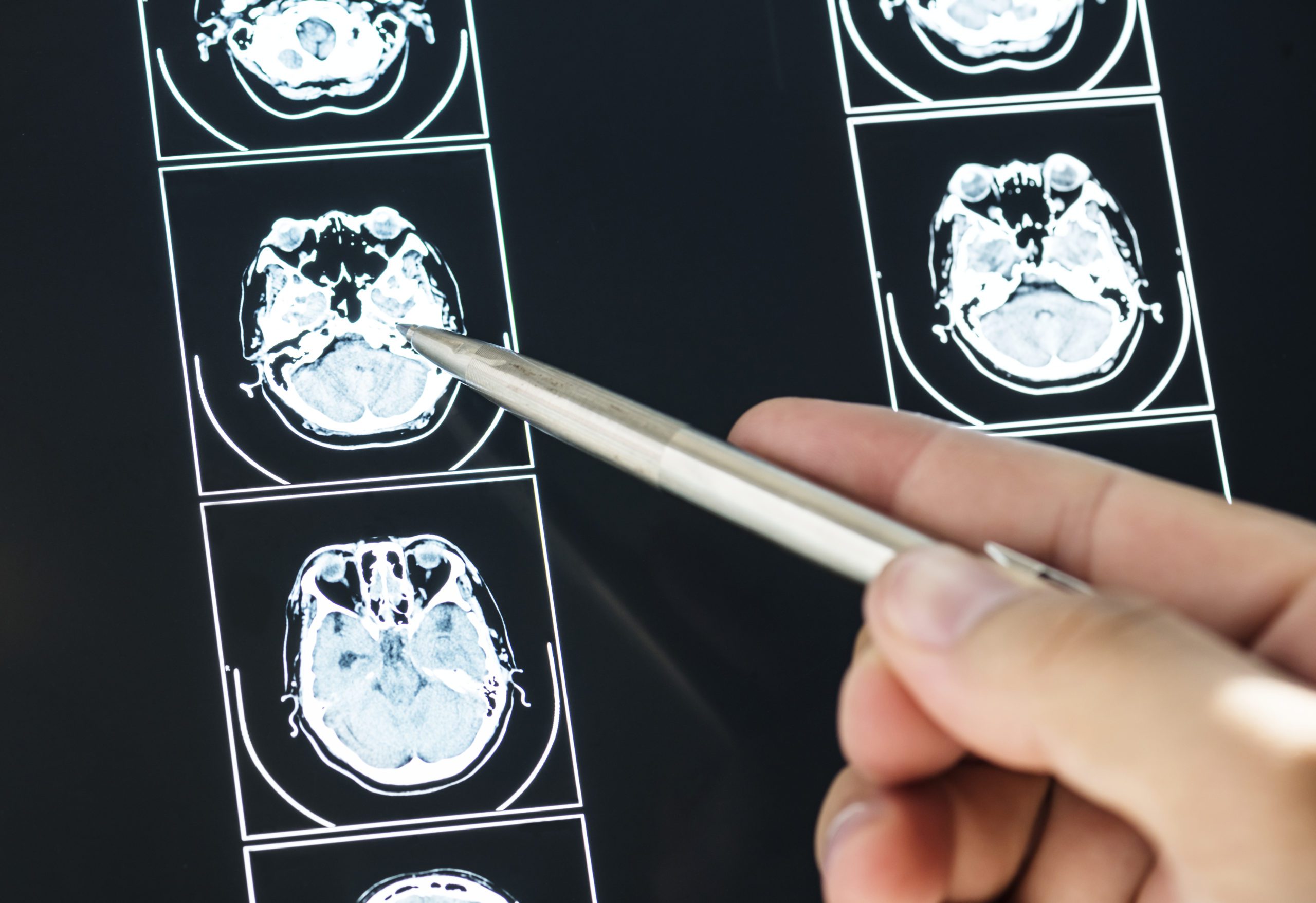 CBD (Cannabidiol) and Its Effect on the Brain